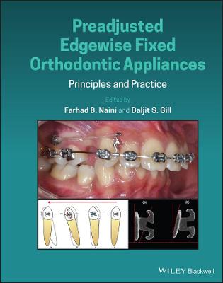 Preadjusted Edgewise Fixed Orthodontic Appliances