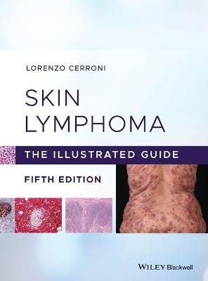 Skin Lymphoma (5th Edition)